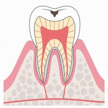 C1　エナメル質の虫歯