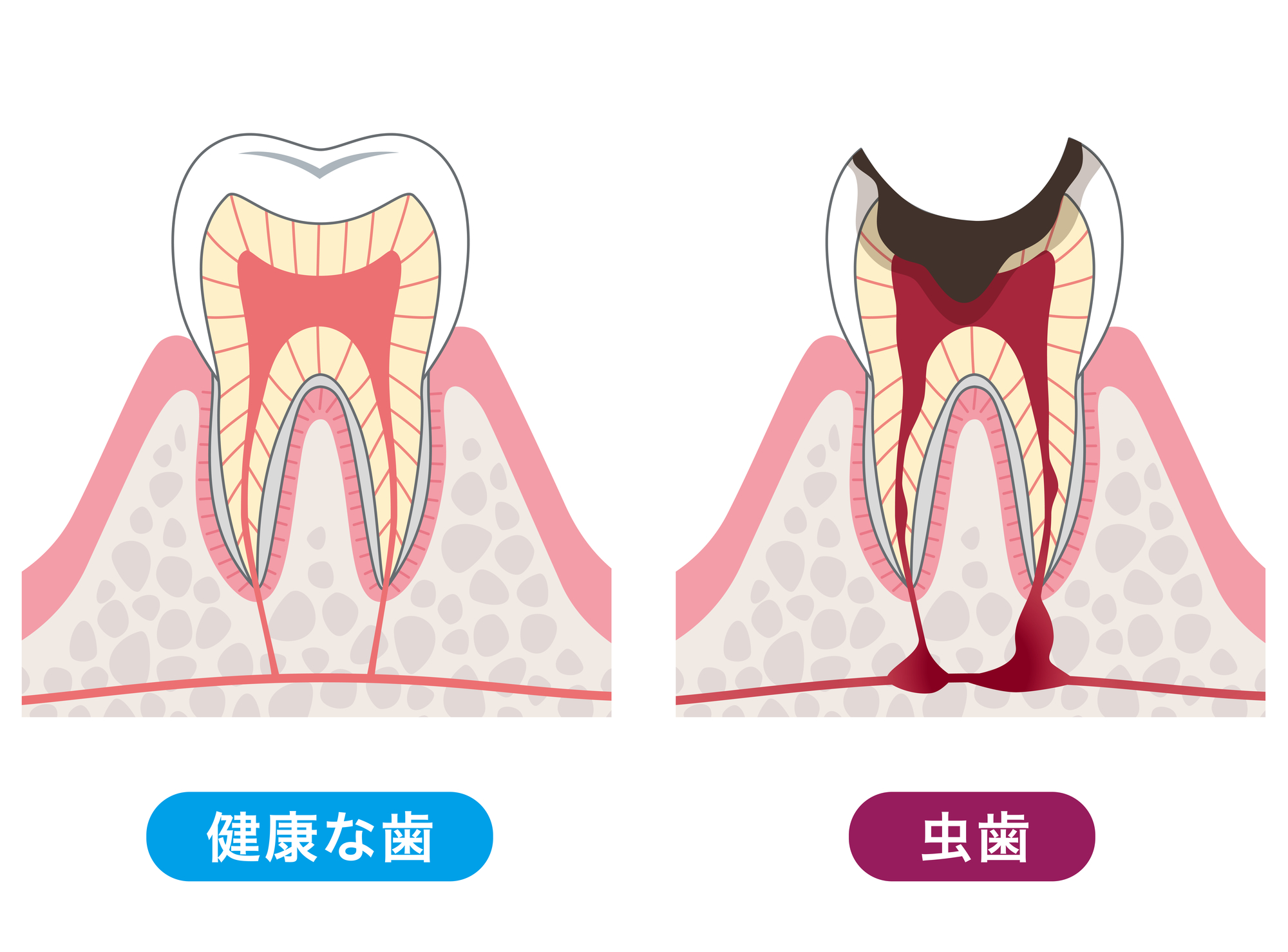 むし歯