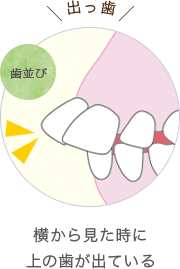 横から見た時に上の歯が出ている