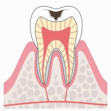 C2　象牙質の虫歯