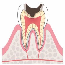 C3　神経に達した虫歯