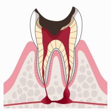 C4　歯根まで達した虫歯