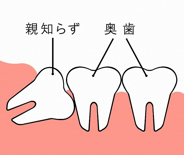 親知らずとは