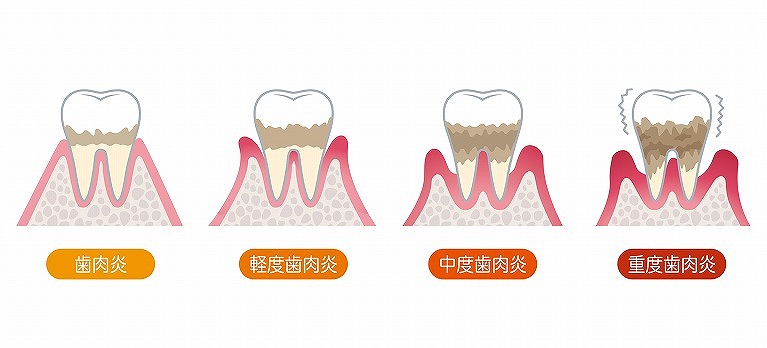 歯茎から血が出る・歯茎が腫れた症状