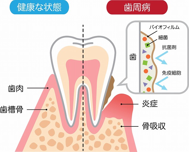 歯周病治療について